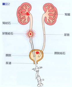 尿路結石症